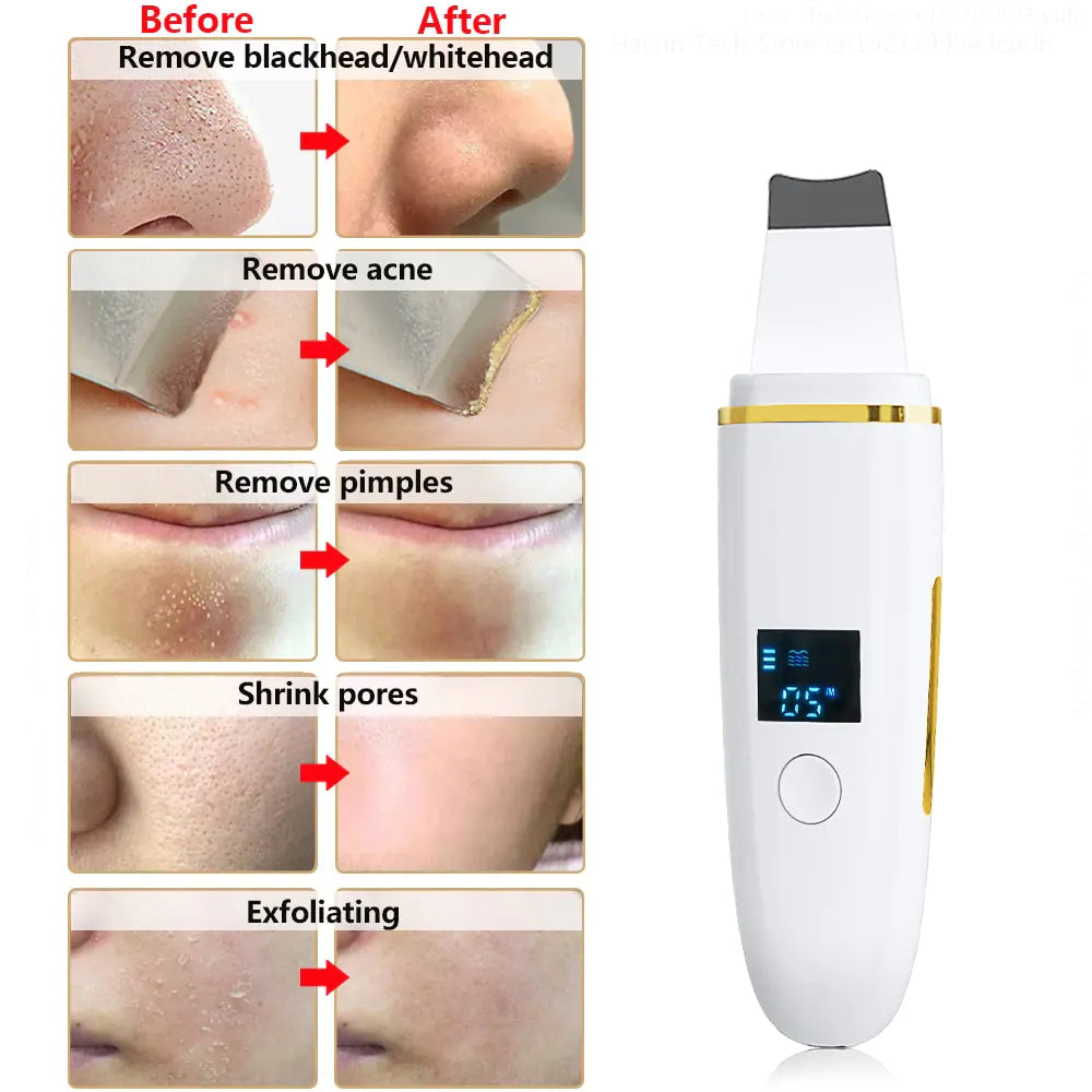 Ultrasonic Skin Scrubber - Nettoyage Visage Professionnel